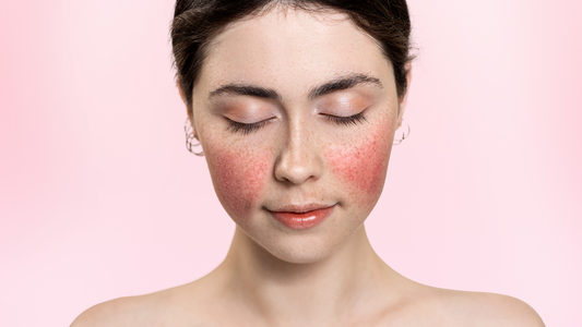 Rosacea, meer dan alleen roodheid
