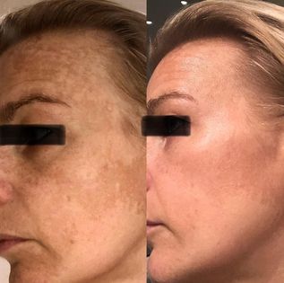 Wiotech Pigment Whitening Serum