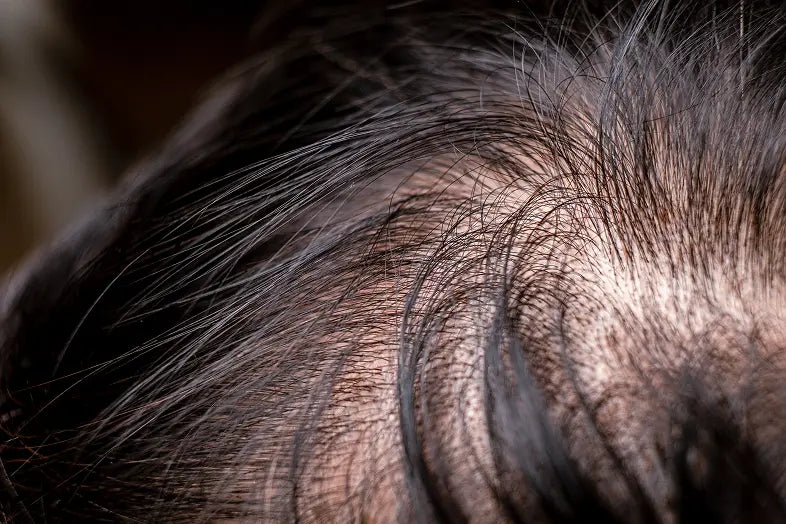 Alopecia androgenetica